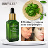 BREYLEE Acne Treatment Serum Facial Facial Anti Acne Scar Removal Cream Skin Care Whitening Repair Pimple Remover For Acne 